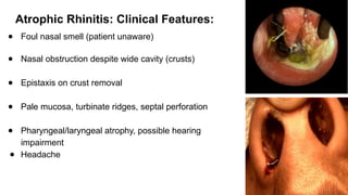 INFLAMMATORY DISEASES OF NOSE (INCLUDING Atrophic rhinitis, Allergic ...