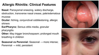 Mild Rhinitis INFLAMMATORY DISEASES OF NOSE (INCLUDING Atrophic rhinitis, Allergic ...
