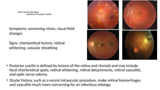 Comprehensive Overview Of Uveitis Classification Diagnosis And comprehensive-overview-of-uveitis-classification-diagnosis-and