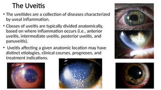 Uveitis Course Comprehensive Overview of Uveitis: Classification, Diagnosis, and ...