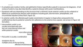 Comprehensive Overview of Uveitis: Classification, Diagnosis, and ...