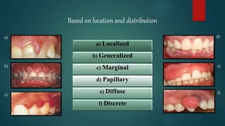 INFLAMMATORY GINGIVAL ENLARGEMENT.pptx