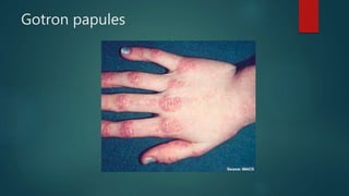 Gotron papules
 