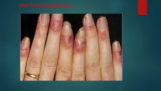 Nail fold telengectasia
 