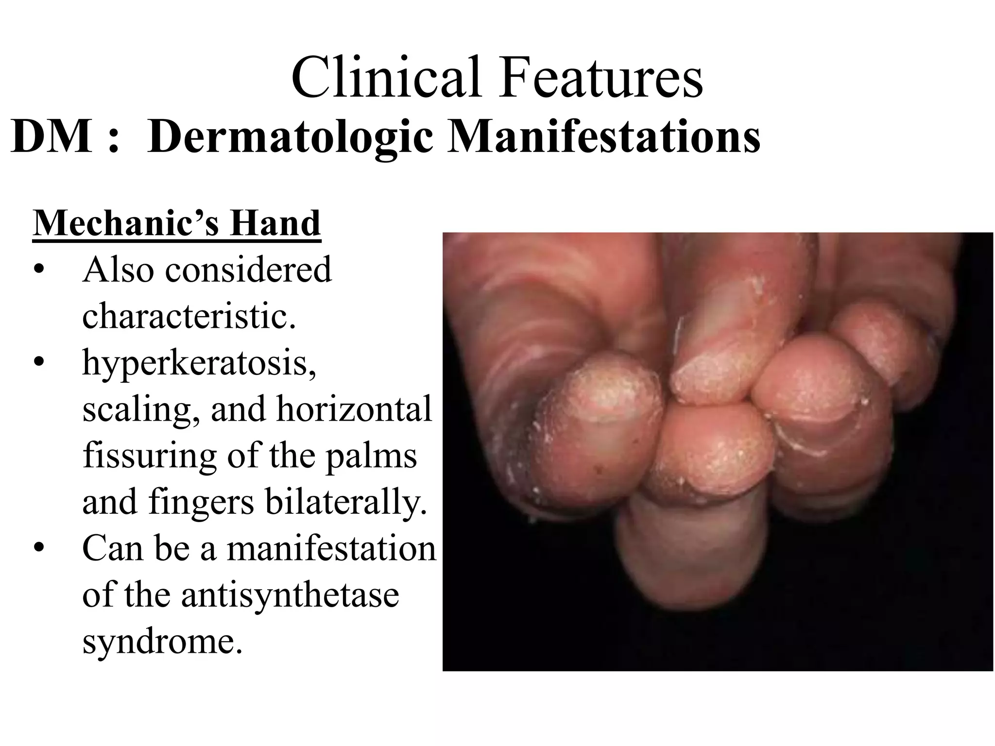 Clinical Features
DM : Dermatologic Manifestations
Mechanic’s Hand
• Also considered
characteristic.
• hyperkeratosis,
scaling, and horizontal
fissuring of the palms
and fingers bilaterally.
• Can be a manifestation
of the antisynthetase
syndrome.
 
