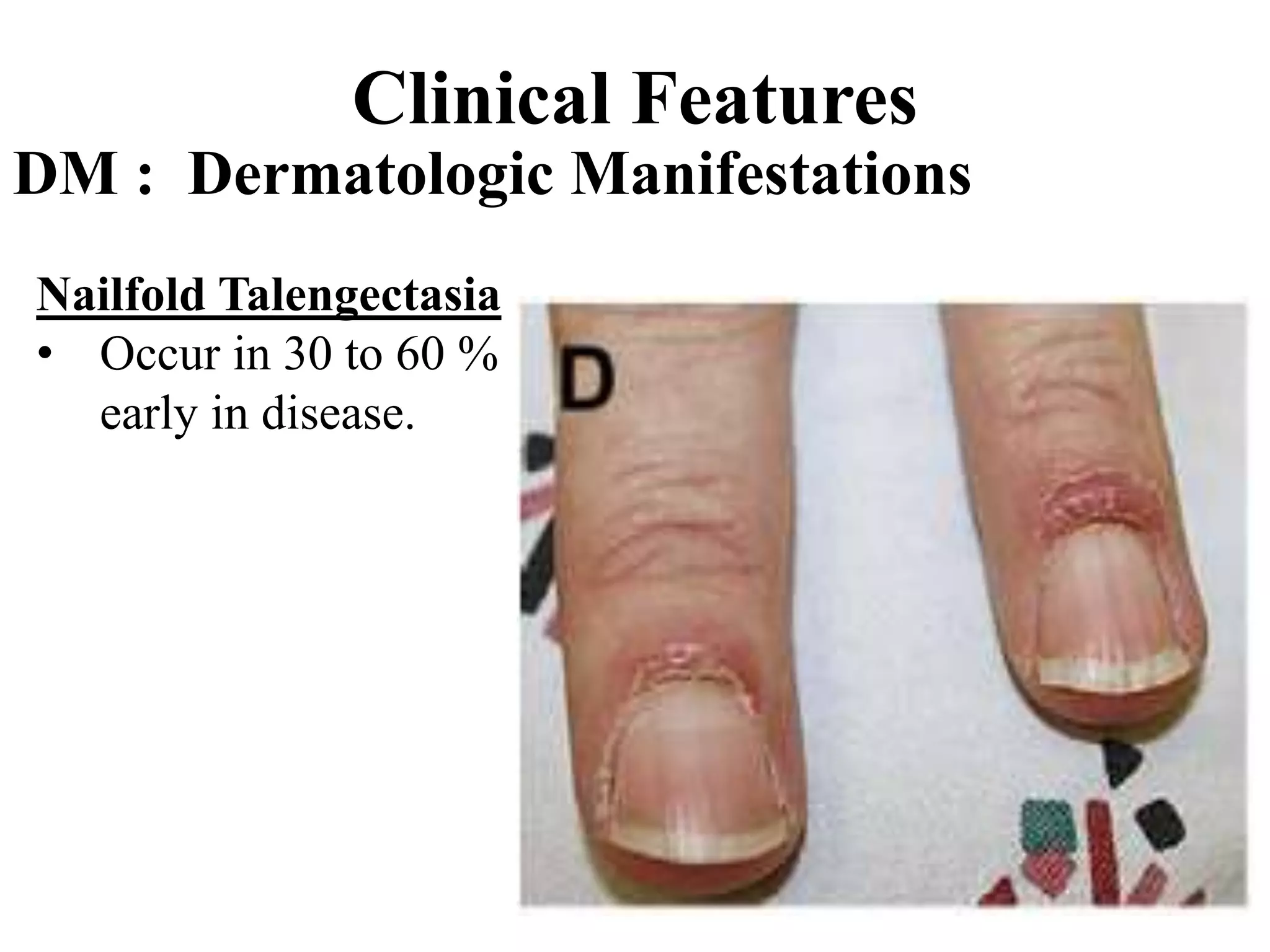 Clinical Features
DM : Dermatologic Manifestations
Nailfold Talengectasia
• Occur in 30 to 60 %
early in disease.
 