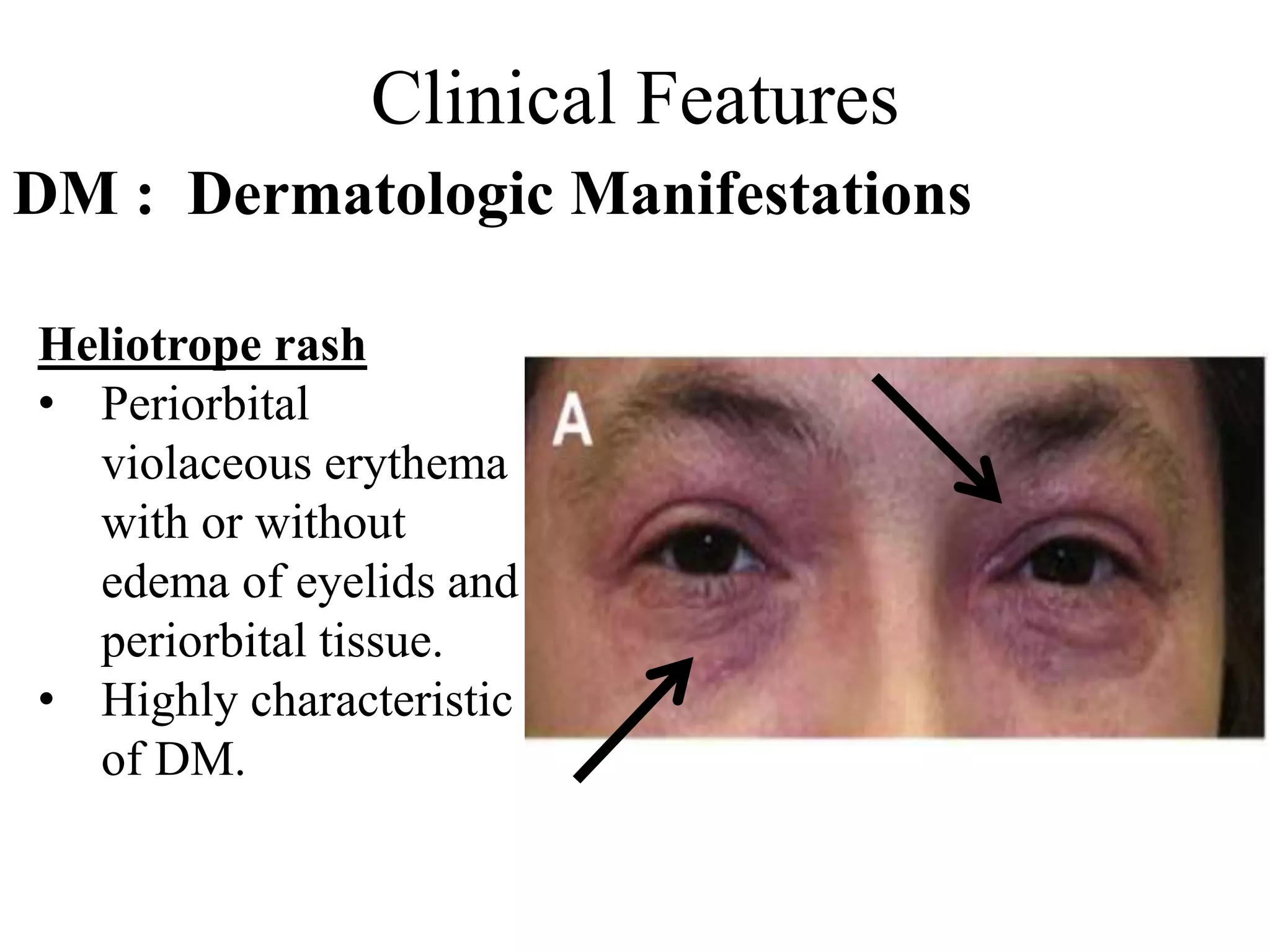 Clinical Features
DM : Dermatologic Manifestations
Heliotrope rash
• Periorbital
violaceous erythema
with or without
edema of eyelids and
periorbital tissue.
• Highly characteristic
of DM.
 