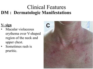 Clinical Features
DM : Dermatologic Manifestations
V- sign
• Macular violaceous
erythema over V-shaped
region of the neck and
upper chest.
• Sometimes rash is
pruritic.
 