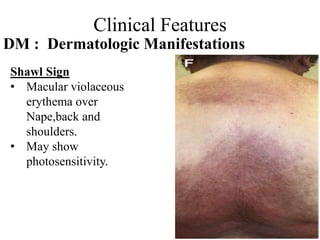 Clinical Features
DM : Dermatologic Manifestations
Shawl Sign
• Macular violaceous
erythema over
Nape,back and
shoulders.
• May show
photosensitivity.
 