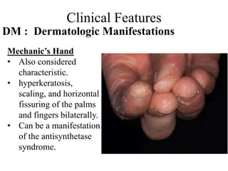 Clinical Features
DM : Dermatologic Manifestations
Mechanic’s Hand
• Also considered
characteristic.
• hyperkeratosis,
scaling, and horizontal
fissuring of the palms
and fingers bilaterally.
• Can be a manifestation
of the antisynthetase
syndrome.
 