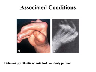 Associated Conditions
Deforming arthritis of anti Jo-1 antibody patient.
 