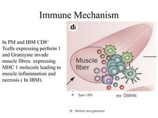 Immune Mechanism
In PM and IBM CD8+
Tcells expressing perforin 1
and Granzyme invade
muscle fibres expressing
MHC 1 molecule leading to
muscle inflammation and
necrosis ( In IBM).
 
