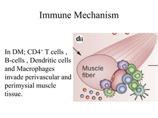 Immune Mechanism
In DM; CD4+ T cells ,
B-cells , Dendritic cells
and Macrophages
invade perivascular and
perimysial muscle
tissue.
 