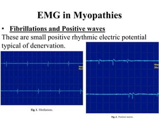 EMG in Myopathies
• Fibrillations and Positive waves
These are small positive rhythmic electric potential
typical of denervation.
 