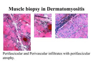 Muscle biopsy in Dermatomyositis
Perifascicular and Perivascular infiltrates with perifascicular
atrophy.
 
