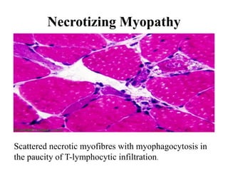 Necrotizing Myopathy
Scattered necrotic myofibres with myophagocytosis in
the paucity of T-lymphocytic infiltration.
 