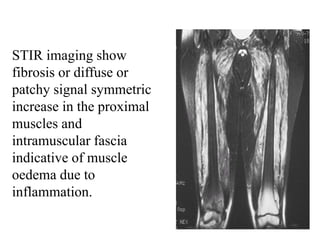 STIR imaging show
fibrosis or diffuse or
patchy signal symmetric
increase in the proximal
muscles and
intramuscular fascia
indicative of muscle
oedema due to
inflammation.
 