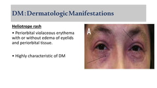 DM:DermatologicManifestations
Heliotrope rash
• Periorbital violaceous erythema
with or without edema of eyelids
and periorbital tissue.
• Highly characteristic of DM
 
