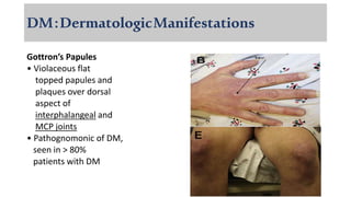 DM:DermatologicManifestations
Gottron’s Papules
• Violaceous flat
topped papules and
plaques over dorsal
aspect of
interphalangeal and
MCP joints
• Pathognomonic of DM,
seen in > 80%
patients with DM
 