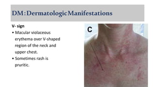 DM:DermatologicManifestations
V- sign
• Macular violaceous
erythema over V-shaped
region of the neck and
upper chest.
• Sometimes rash is
pruritic.
 