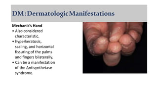 DM:DermatologicManifestations
Mechanic’s Hand
• Also considered
characteristic.
• hyperkeratosis,
scaling, and horizontal
fissuring of the palms
and fingers bilaterally.
• Can be a manifestation
of the Antisynthetase
syndrome.
 