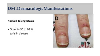 DM:DermatologicManifestations
Nailfold Talengectasia
• Occur in 30 to 60 %
early in disease
 