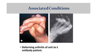 AssociatedConditions
• Deforming arthritis of anti Jo-1
antibody patient.
 