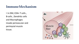 ImmuneMechanism
• In DM; CD4+ T cells ,
B-cells , Dendritic cells
and Macrophages
invade perivascular and
perimysial muscle
tissue.
 