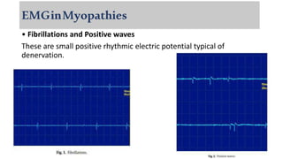 EMGinMyopathies
• Fibrillations and Positive waves
These are small positive rhythmic electric potential typical of
denervation.
 