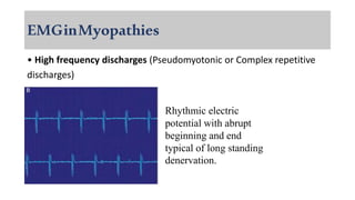 EMGinMyopathies
• High frequency discharges (Pseudomyotonic or Complex repetitive
discharges)
Rhythmic electric
potential with abrupt
beginning and end
typical of long standing
denervation.
 