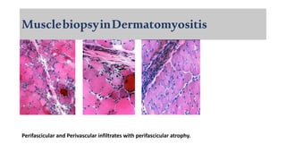 MusclebiopsyinDermatomyositis
Perifascicular and Perivascular infiltrates with perifascicular atrophy.
 