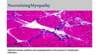 NecrotizingMyopathy
Scattered necrotic myofibres with myophagocytosis in the paucity of T-lymphocytic
infiltration.
 