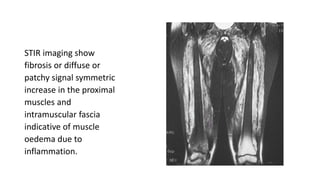 STIR imaging show
fibrosis or diffuse or
patchy signal symmetric
increase in the proximal
muscles and
intramuscular fascia
indicative of muscle
oedema due to
inflammation.
 