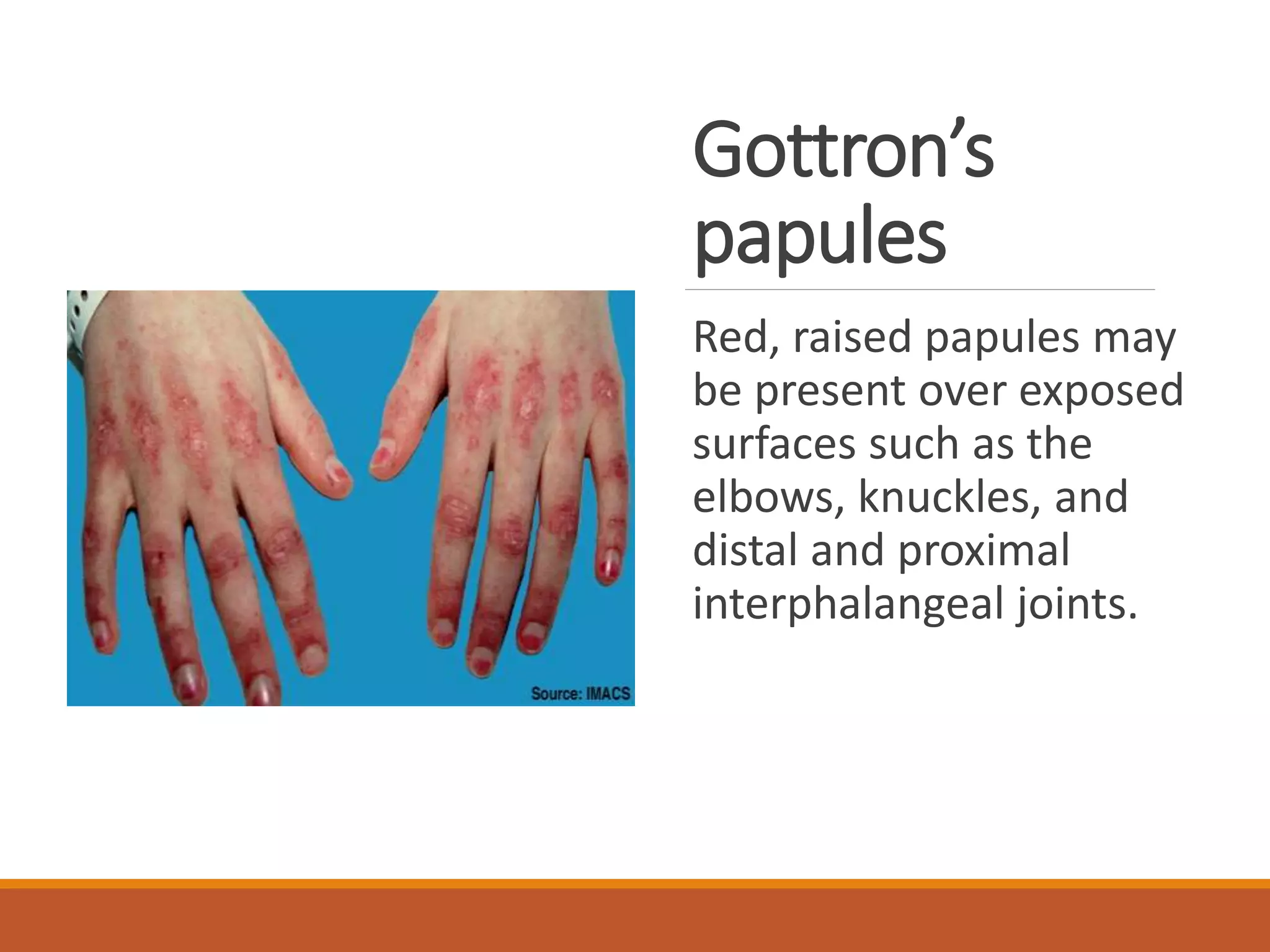 Gottron’s
papules
Red, raised papules may
be present over exposed
surfaces such as the
elbows, knuckles, and
distal and proximal
interphalangeal joints.
 