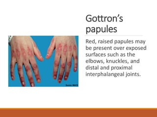 Gottron’s
papules
Red, raised papules may
be present over exposed
surfaces such as the
elbows, knuckles, and
distal and proximal
interphalangeal joints.
 