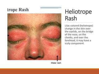 Heliotrope
Rash
Lilac-colored (heliotrope)
change in the skin over
the eyelids, on the bridge
of the nose, on the
cheeks, and over the
forehead; it may have a
scaly component.
 
