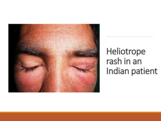 Heliotrope
rash in an
Indian patient
 
