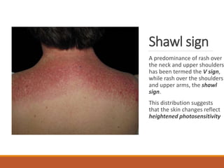 Shawl sign
A predominance of rash over
the neck and upper shoulders
has been termed the V sign,
while rash over the shoulders
and upper arms, the shawl
sign.
This distribution suggests
that the skin changes reflect
heightened photosensitivity
 