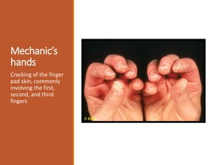 Mechanic’s
hands
Cracking of the finger
pad skin, commonly
involving the first,
second, and third
fingers
 