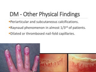 DM - Other Physical Findings
Periarticular and subcutaneous calcifications.
Raynaud phenomenon in almost 1/3rd of patients.
Dilated or thrombosed nail-fold capillaries.
 