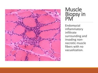Muscle
Biopsy in
PM
Endomysial
inflammatory
infiltrate
surrounding and
invading non-
necrotic muscle
fibers with no
vacuolization.
 