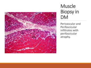 Muscle
Biopsy in
DM
Perivascular and
Perifascicular
infiltrates with
perifascicular
atrophy.
 