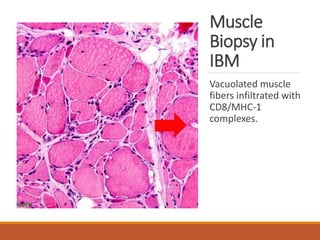 Muscle
Biopsy in
IBM
Vacuolated muscle
fibers infiltrated with
CD8/MHC-1
complexes.
 