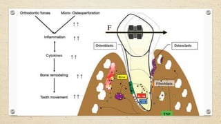 Influence of Drugs on Orthodontic Tooth Movement | PPTX
