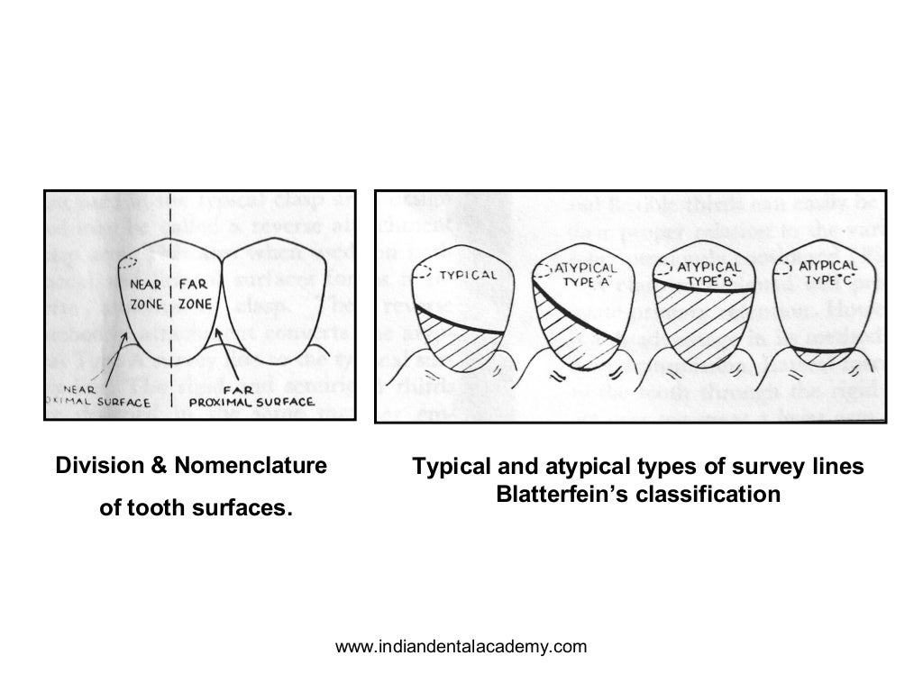 Influence of survey line on designing of clasp / dental implant cours…