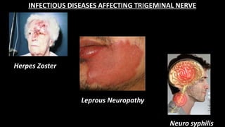 Leprous Neuropathy
INFECTIOUS DISEASES AFFECTING TRIGEMINAL NERVE
Neuro syphilis
Herpes Zoster
 