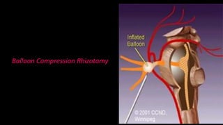 Balloon Compression Rhizotomy
 