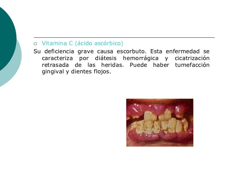 Elton a la psoriasis