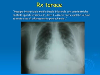 Rx torace “ impegno interstiziale medio-basale bilaterale con centimetriche multiple opacità ovalari a sn, dove si osserva anche qualche iniziale sfumata area di addensamento parenchimale..” 
