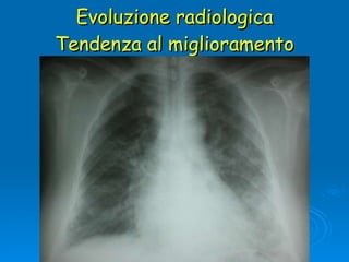Evoluzione radiologica Tendenza al miglioramento 